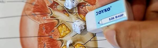 عکس سنگ کلیه ۵ میلیمتری