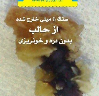 عکس سنگ کلیه ۵ میلیمتری