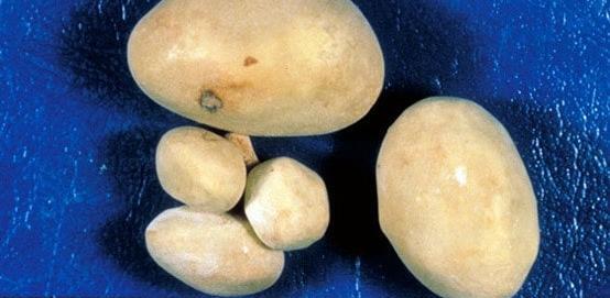 عکس سنگ کلیه 8 میلیمتری