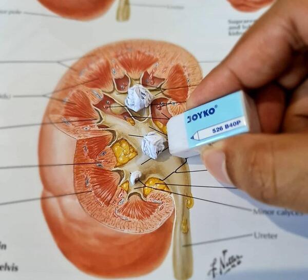 عکس سنگ کلیه ۱۷ میلیمتری