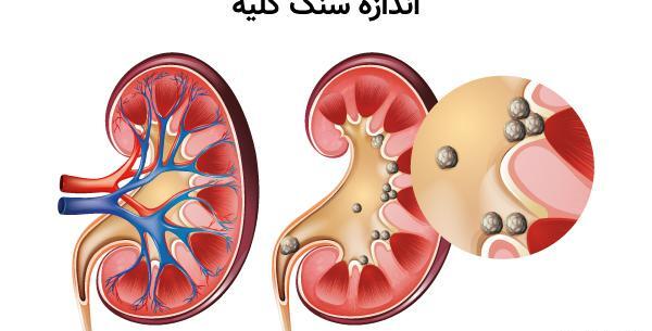 عکس سنگ کلیه ۱۷ میلیمتری