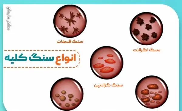 عکس سنگ کلیه ۱۷ میلیمتری