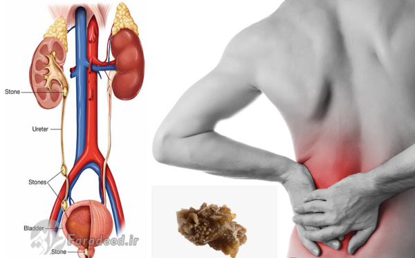 عکس بزرگترین سنگ کلیه