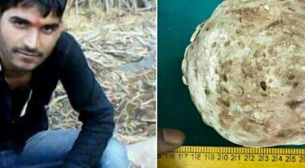 عکس بزرگترین سنگ کلیه