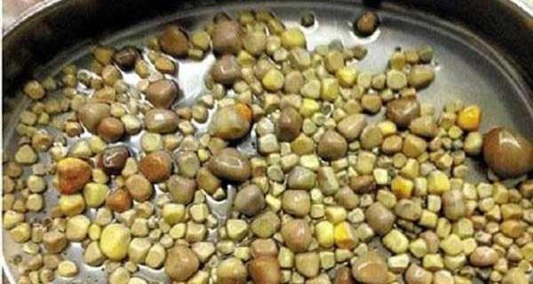 عکس بزرگترین سنگ کلیه