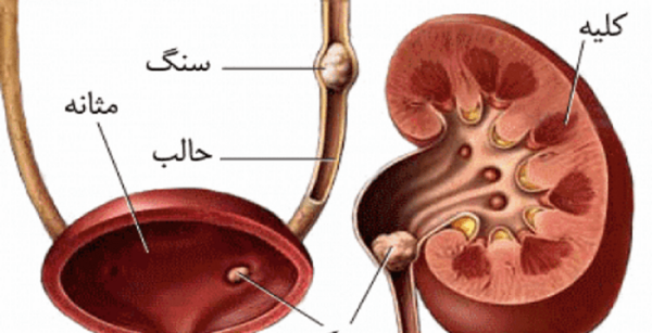 عکس بزرگترین سنگ کلیه