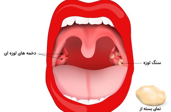 عکس بزرگترین سنگ لوزه
