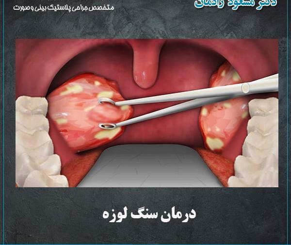 عکس بزرگترین سنگ لوزه
