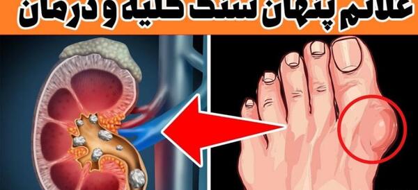 عکس سنگ ریزه در کلیه