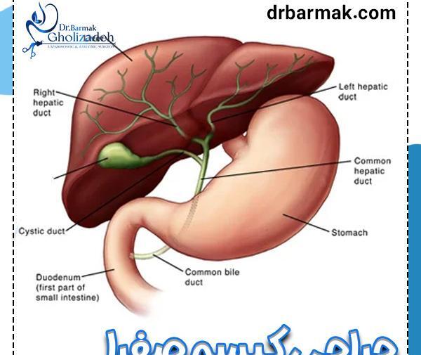 عکس کیسه صفرا پر از سنگ