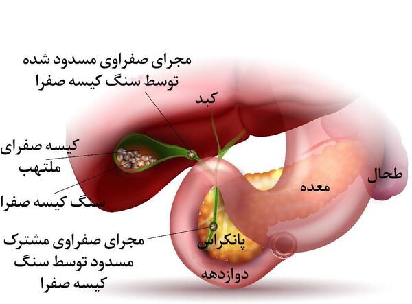 عکس کیسه صفرا پر از سنگ
