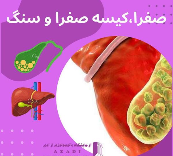 عکس کیسه صفرا پر از سنگ