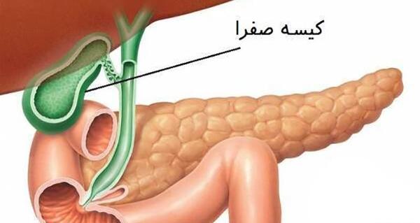 عکس کیسه صفرا پر از سنگ