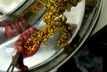 عکس کیسه صفرا پر از سنگ