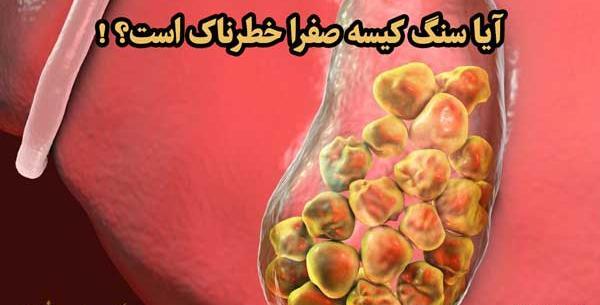 عکس کیسه صفرا پر از سنگ
