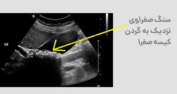 عکس سونوگرافی سنگ کیسه صفرا