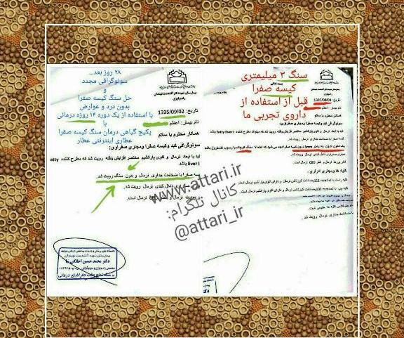 عکس سونوگرافی سنگ کیسه صفرا