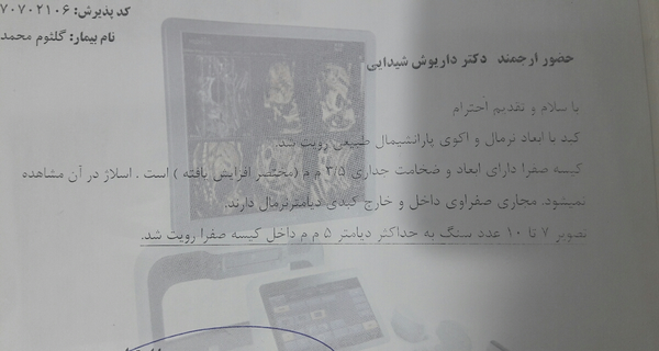 عکس سونوگرافی سنگ کیسه صفرا