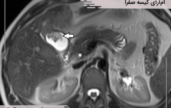 عکس سونوگرافی سنگ کیسه صفرا