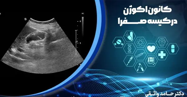 عکس سونوگرافی سنگ کیسه صفرا