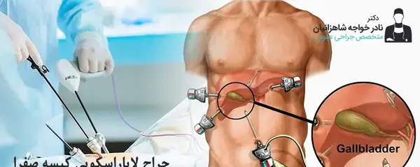 عکس عمل سنگ کیسه صفرا