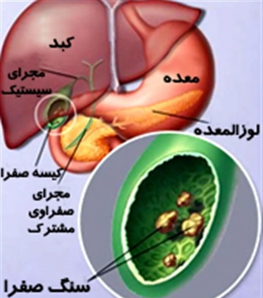 عکس عمل سنگ کیسه صفرا