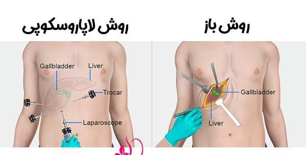 عکس عمل سنگ کیسه صفرا