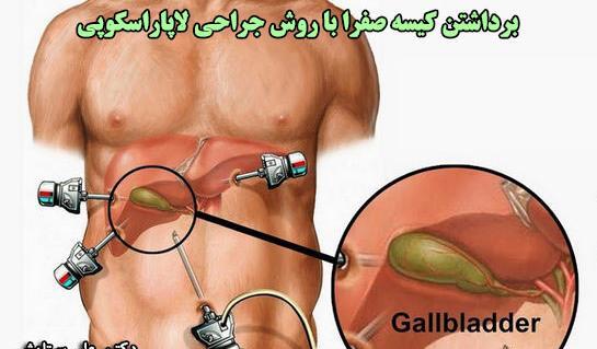 عکس عمل سنگ کیسه صفرا