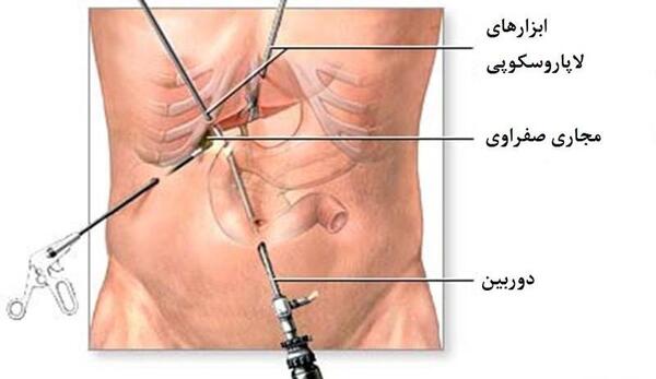 عکس عمل سنگ کیسه صفرا