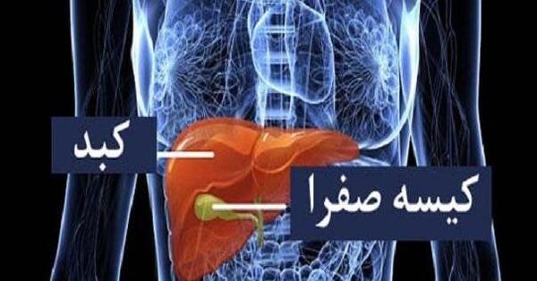 عکس سنگ در کیسه صفرا