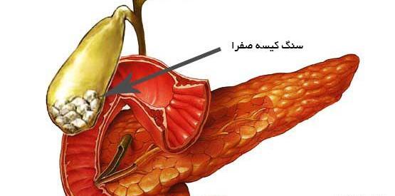 عکس سنگ در کیسه صفرا