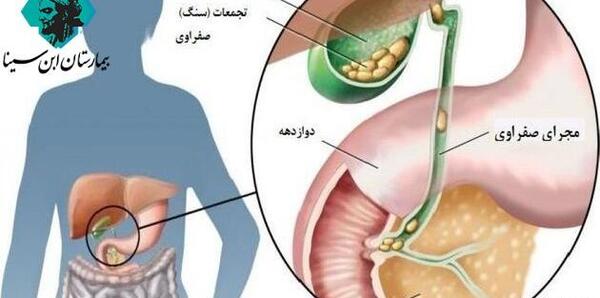 عکس سنگ در کیسه صفرا