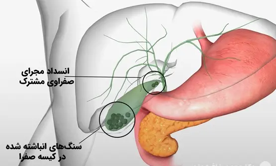 عکس سنگ در کیسه صفرا