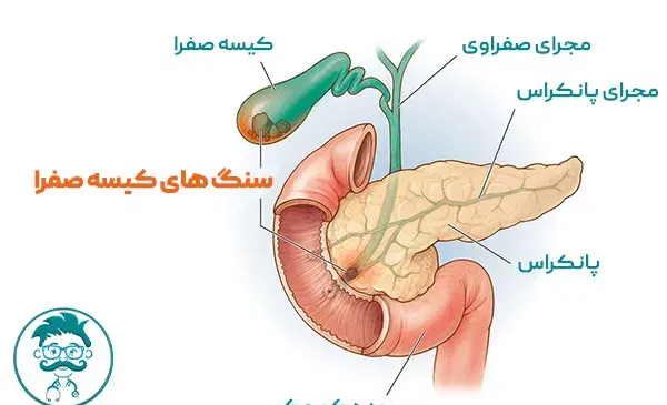 عکس سنگ های کیسه صفرا