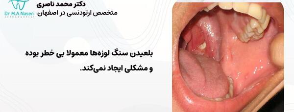 عکس سنگ لوزه در کودکان