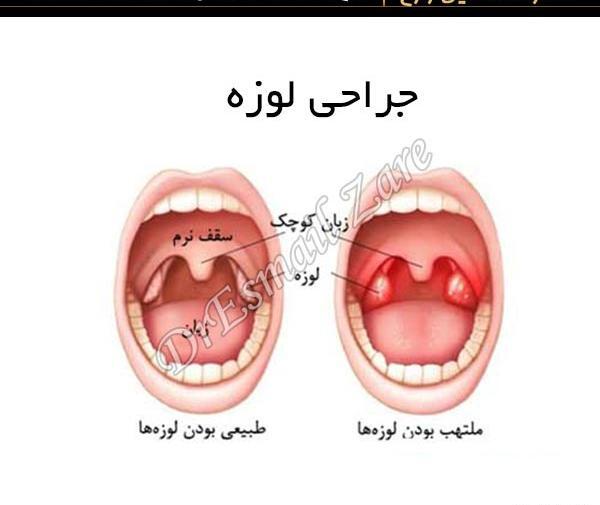 عکس سنگ لوزه بزرگ