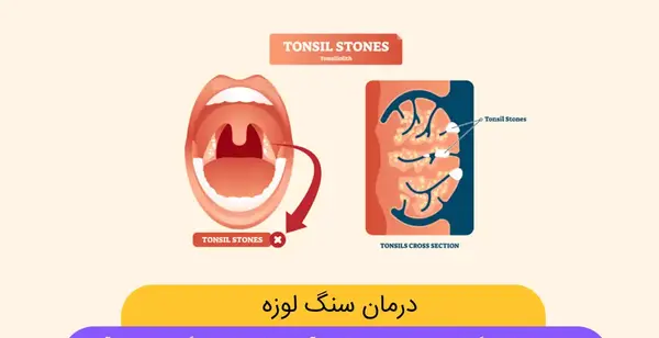 عکس سنگ لوزه در گلو