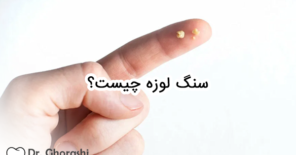 عکس سنگ لوزه در گلو