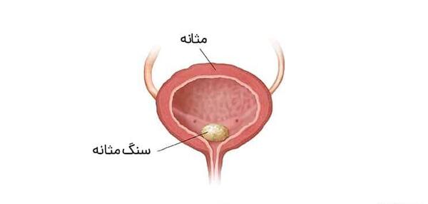 عکس سنگ مثانه در زنان