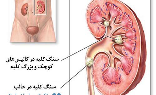 عکس سنگ مثانه بزرگ