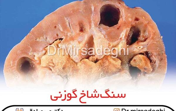 عکس سنگ مثانه بزرگ