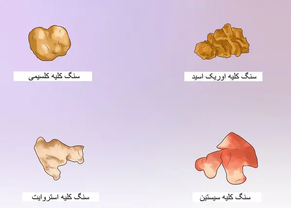 عکس سنگ مثانه بزرگ