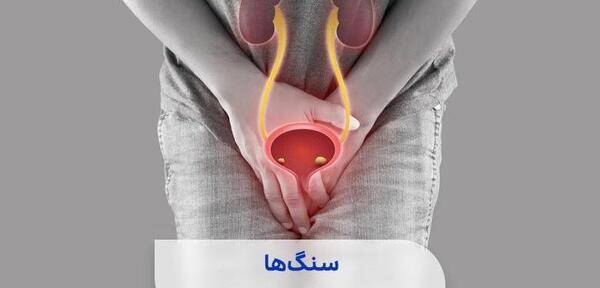 عکس سنگ مثانه بزرگ