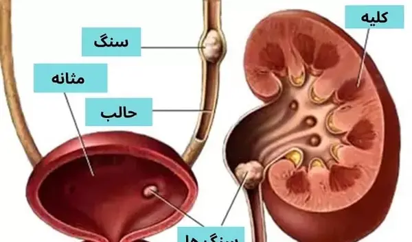 عکس سنگ در مثانه