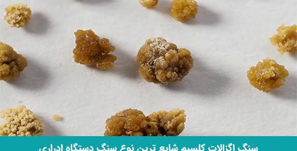عکس سنگ در مثانه
