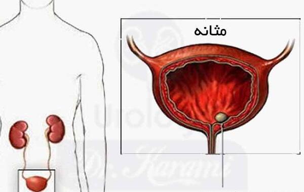 عکس سنگ در مثانه