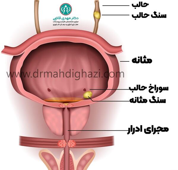عکس سنگ در مثانه