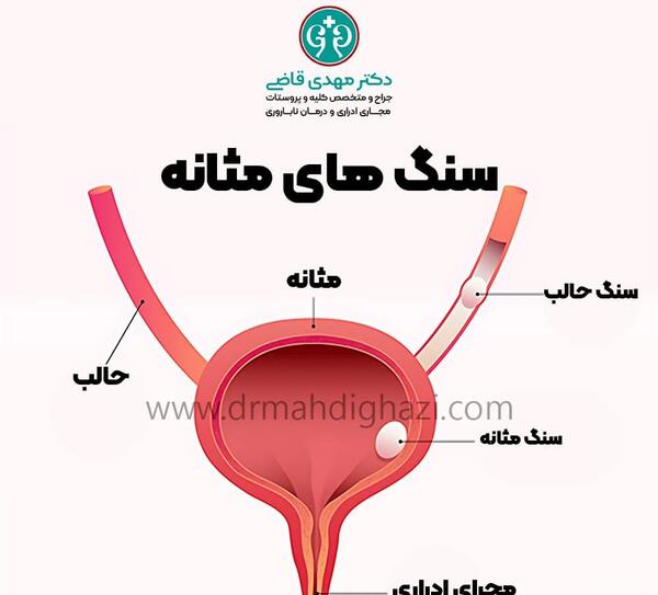 عکس سنگ در مثانه