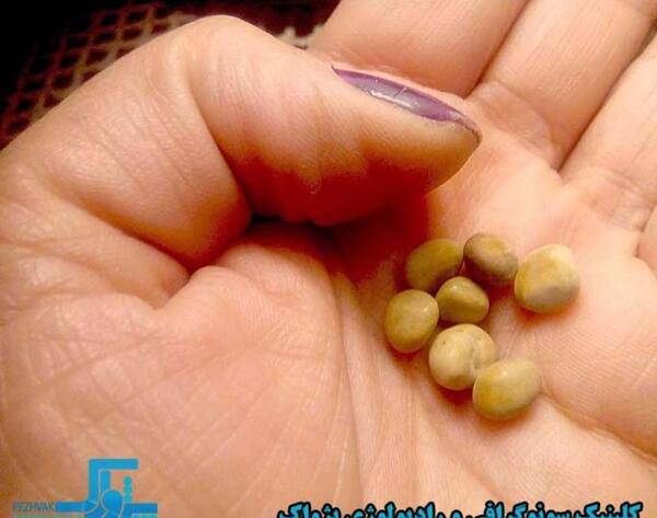 عکس سنگ در مثانه