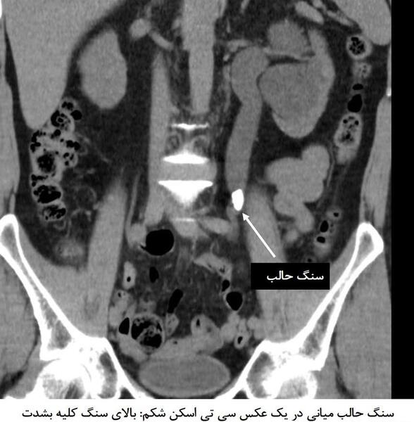 عکس سنگ در مثانه